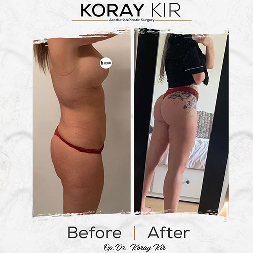 before-after