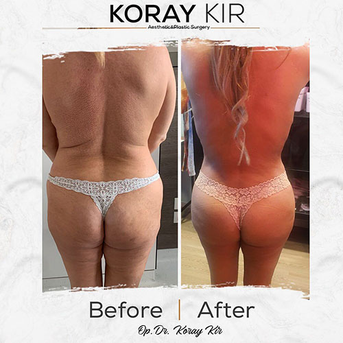before-after