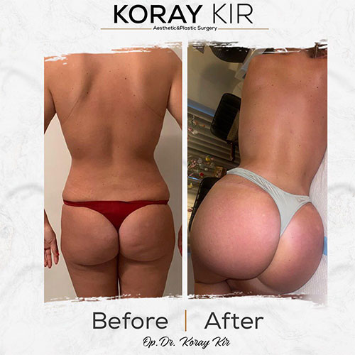 before-after