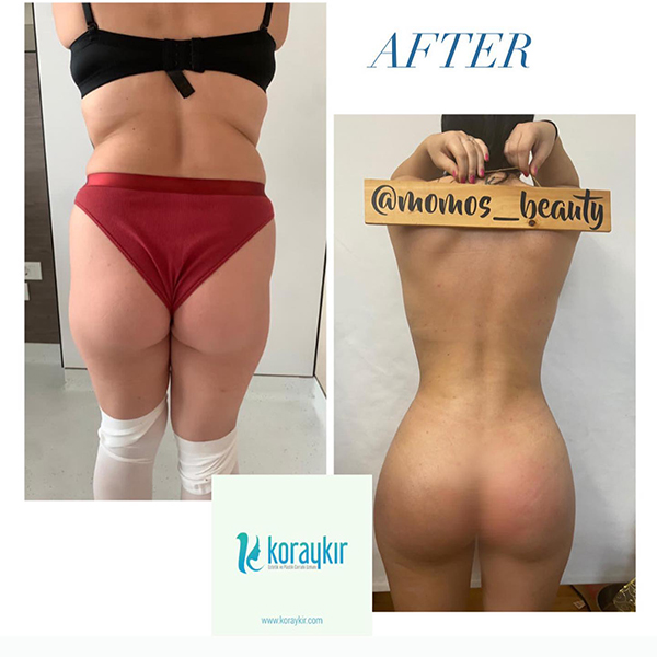before-after