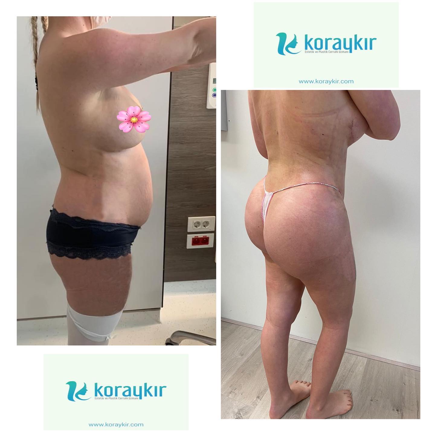 before-after