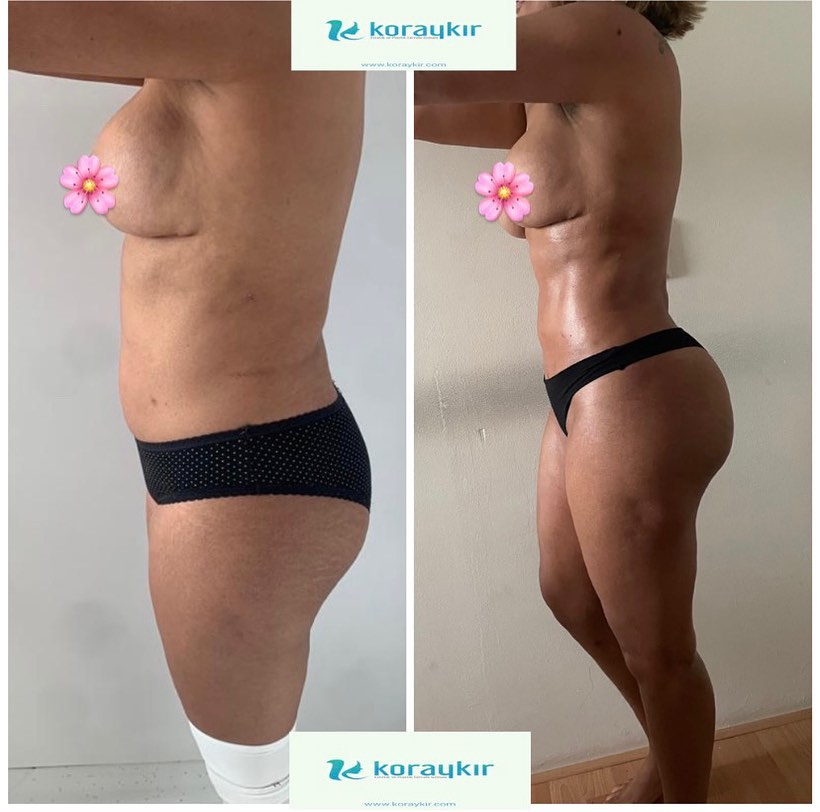 before-after