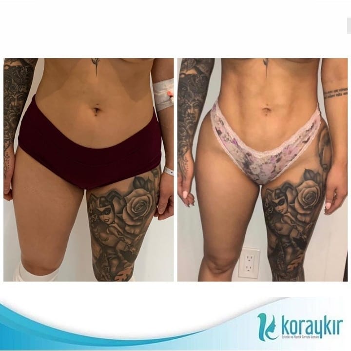 before-after