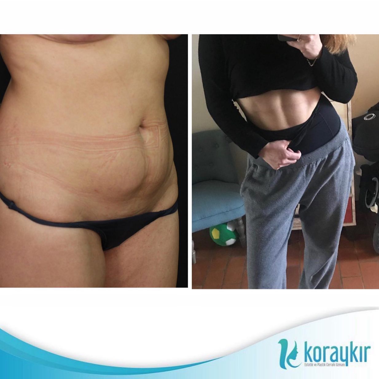 before-after