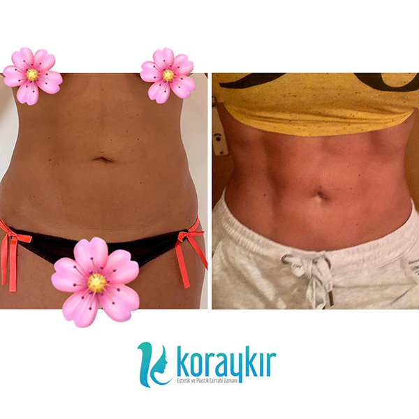 before-after