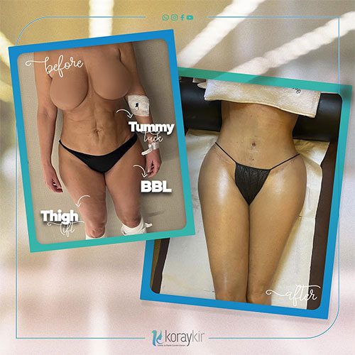 before-after