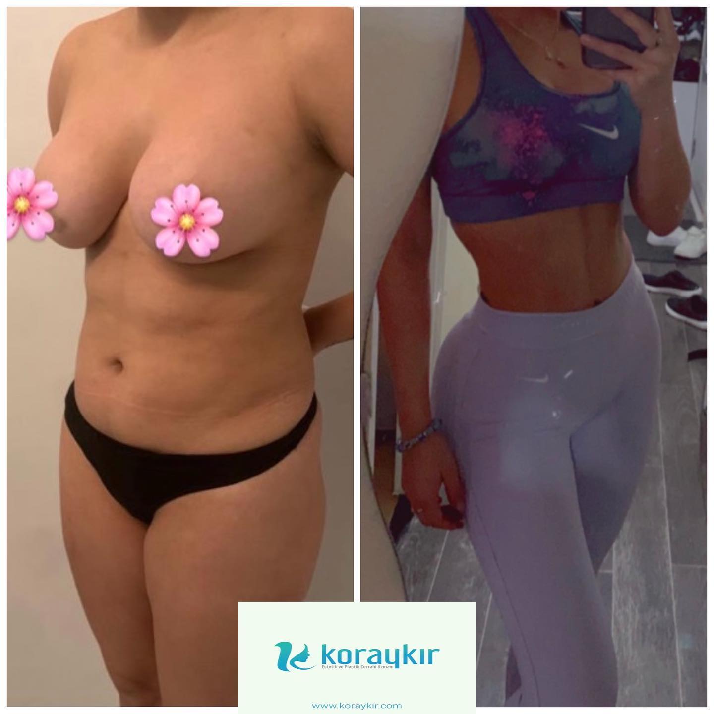 before-after