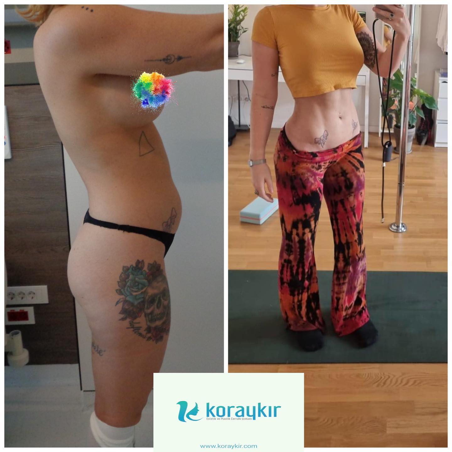 before-after
