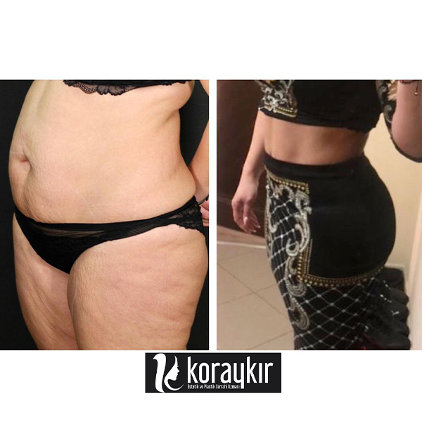before-after