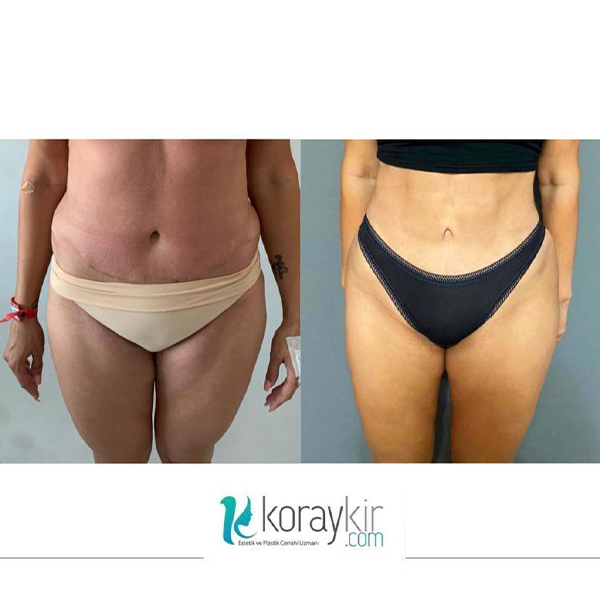before-after