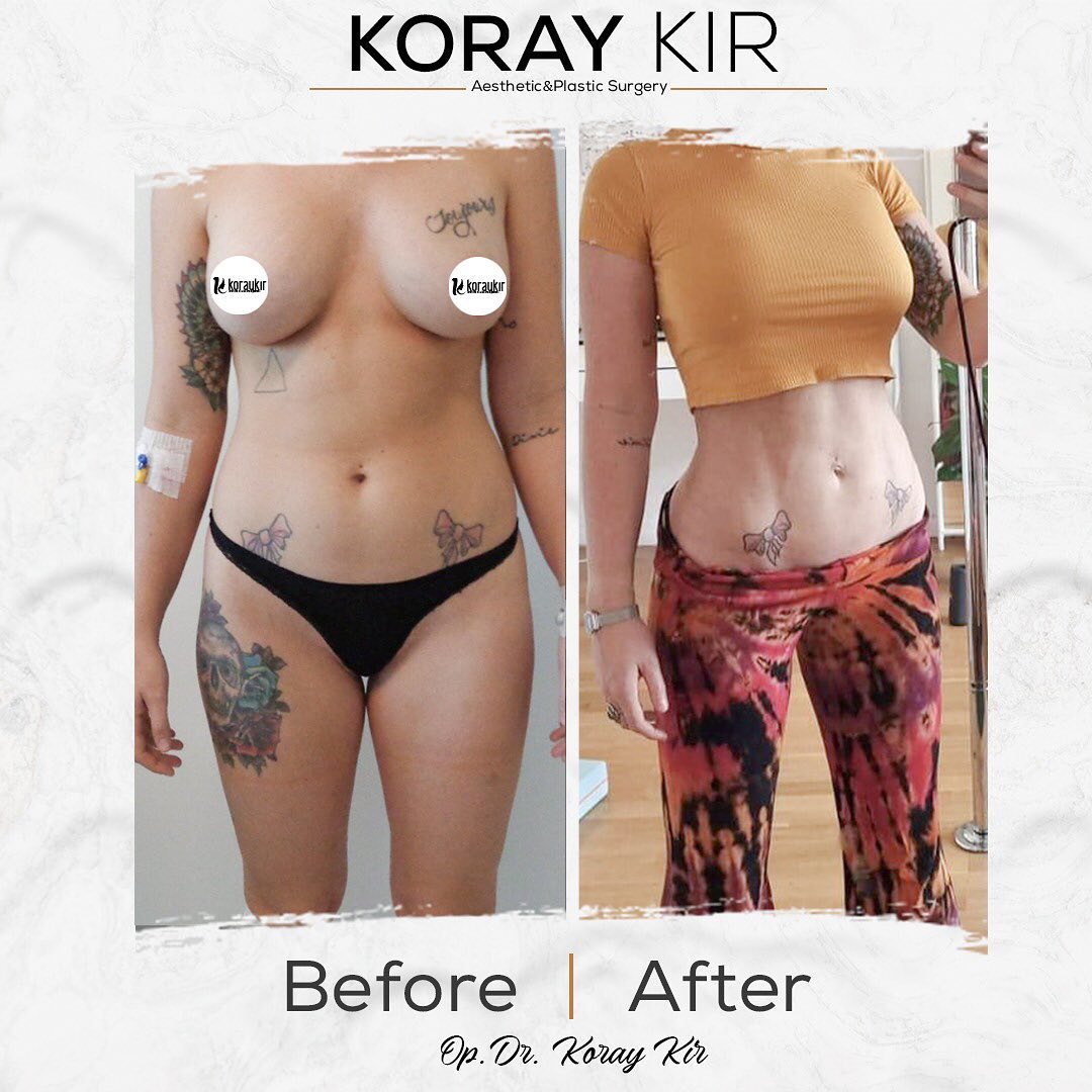 before-after