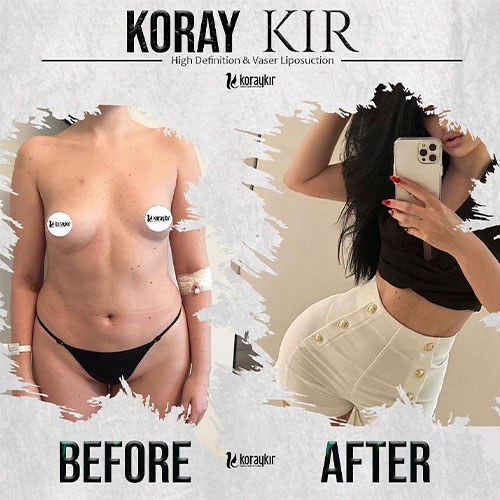 before-after