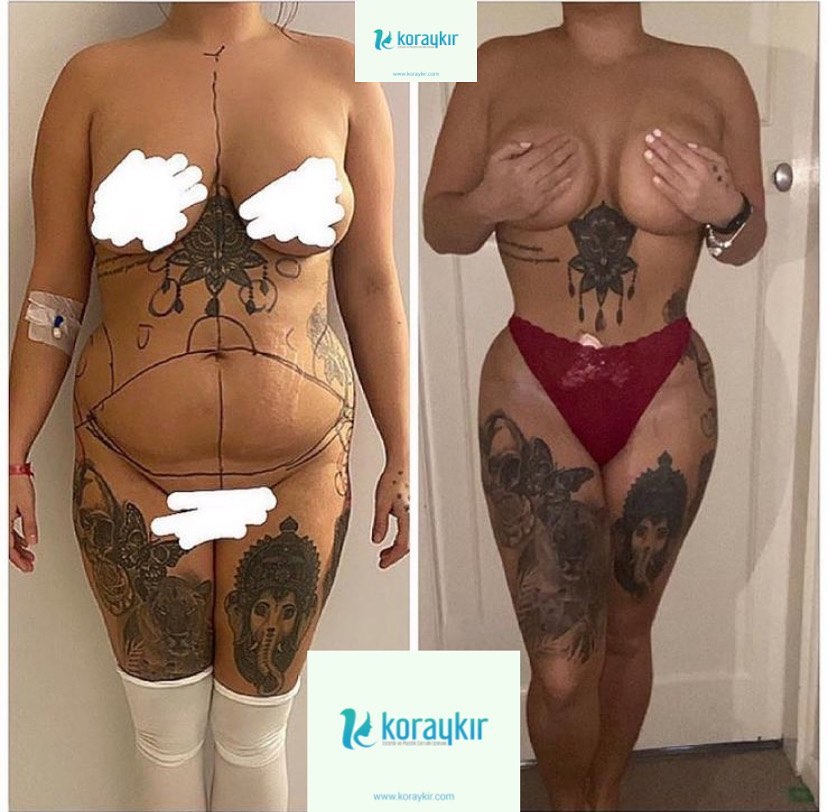 before-after