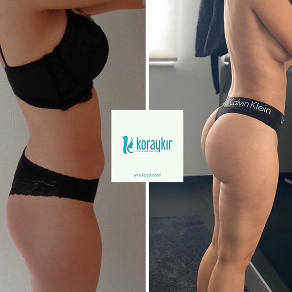 before-after