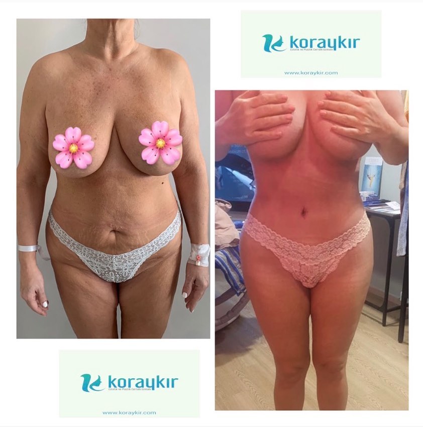 before-after