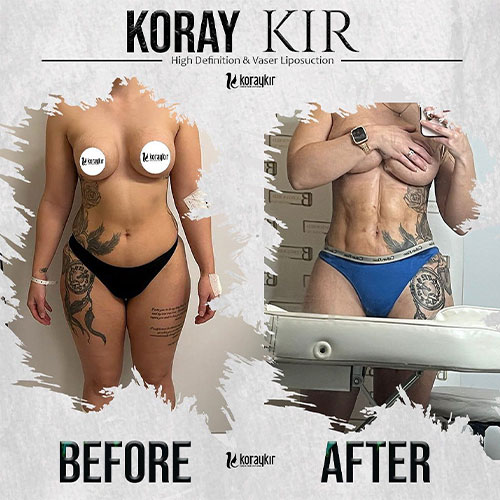 before-after