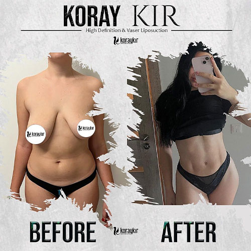 before-after
