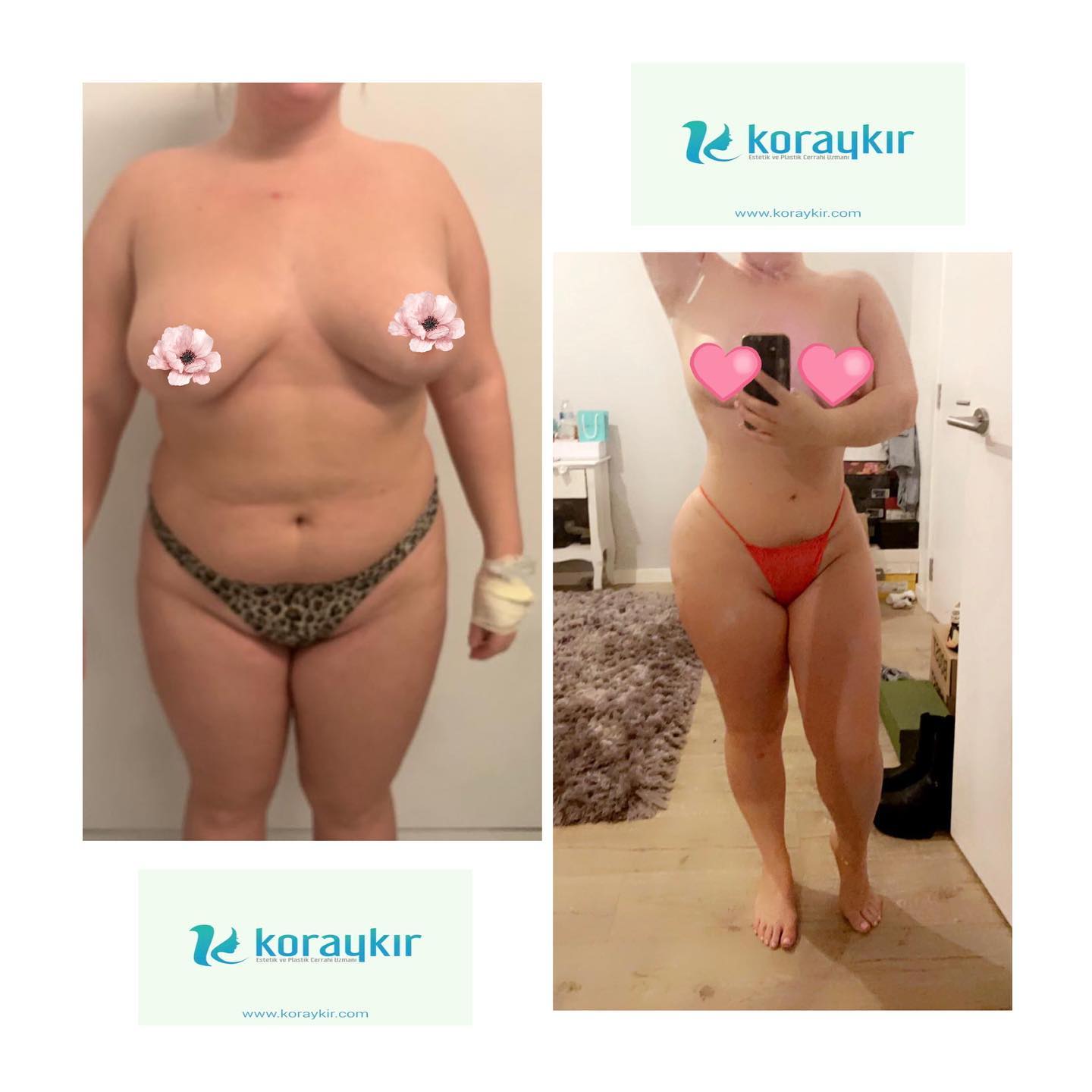 before-after