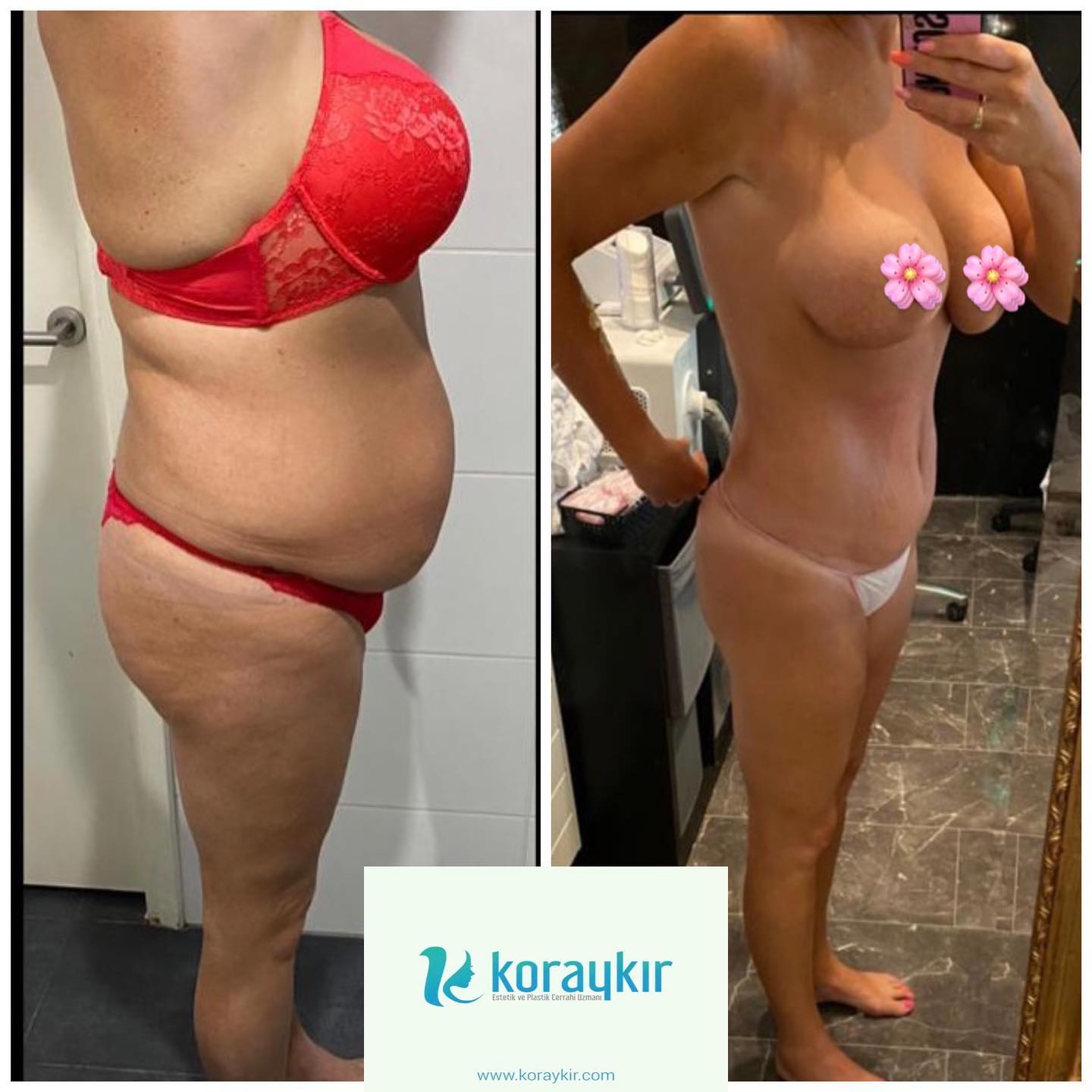 before-after