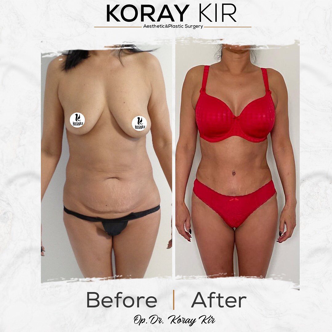 before-after
