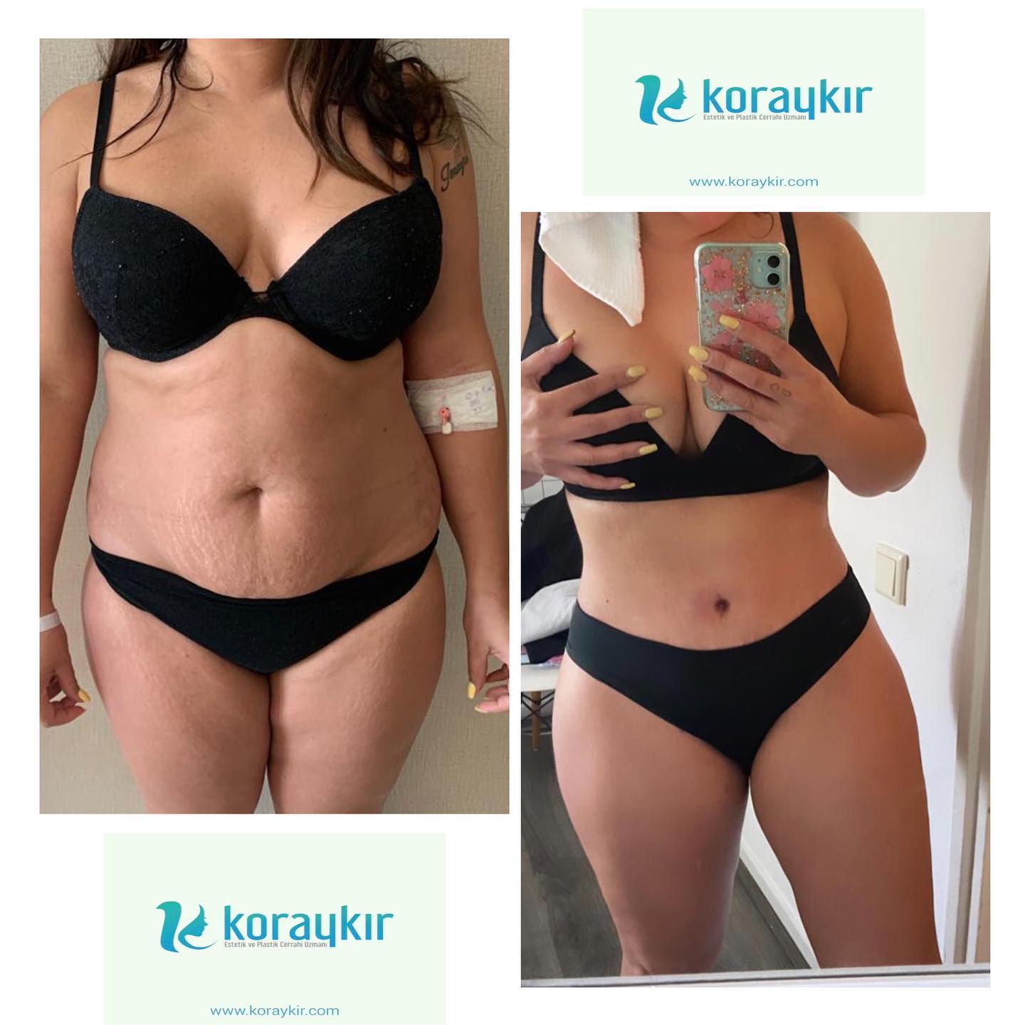 before-after