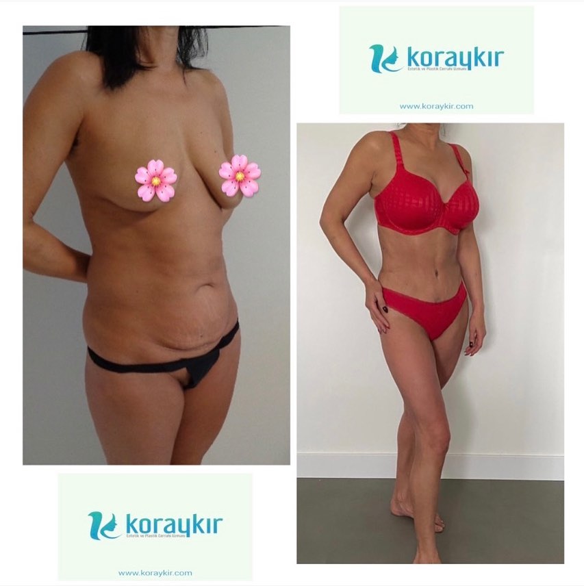 before-after