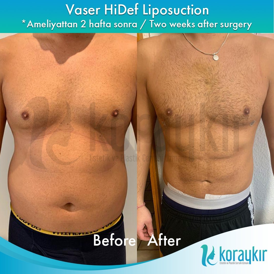 before-after