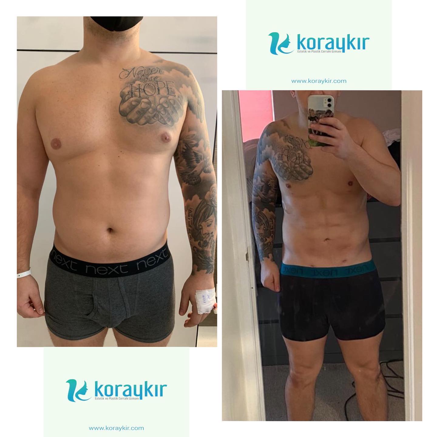 before-after