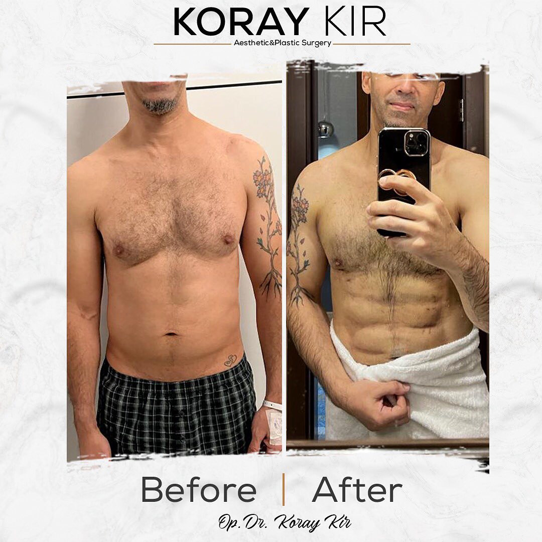 before-after
