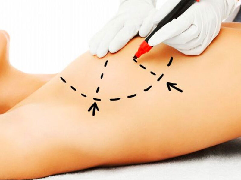 Silicone Implant Placement in Breast Augmentation