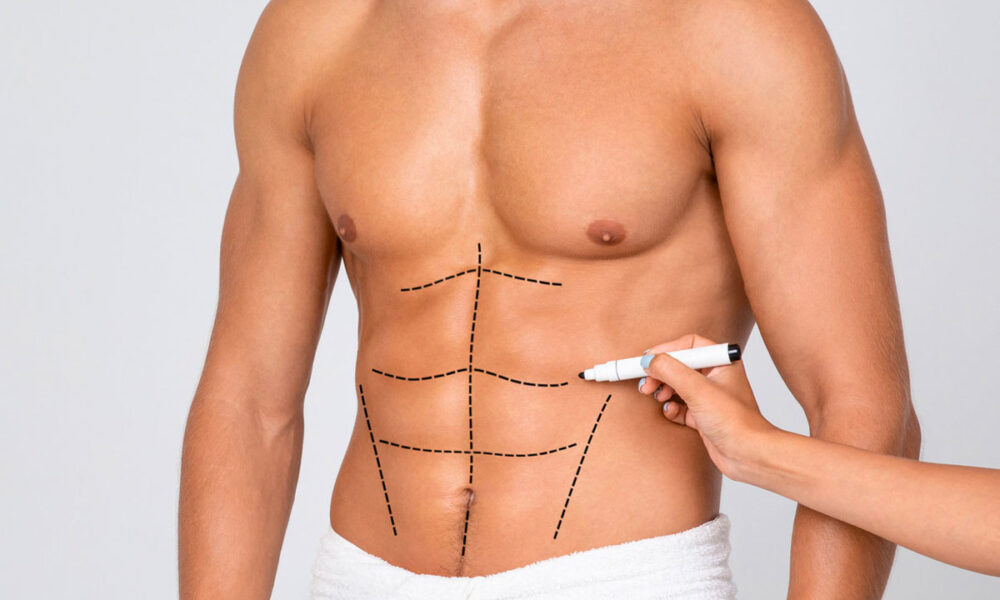 Sixpack Op  (Six Pack Liposuktion)  Dr. Koray Kr
